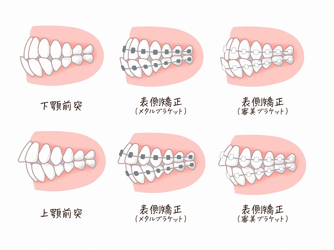 お子さまの歯並び気になりませんか？