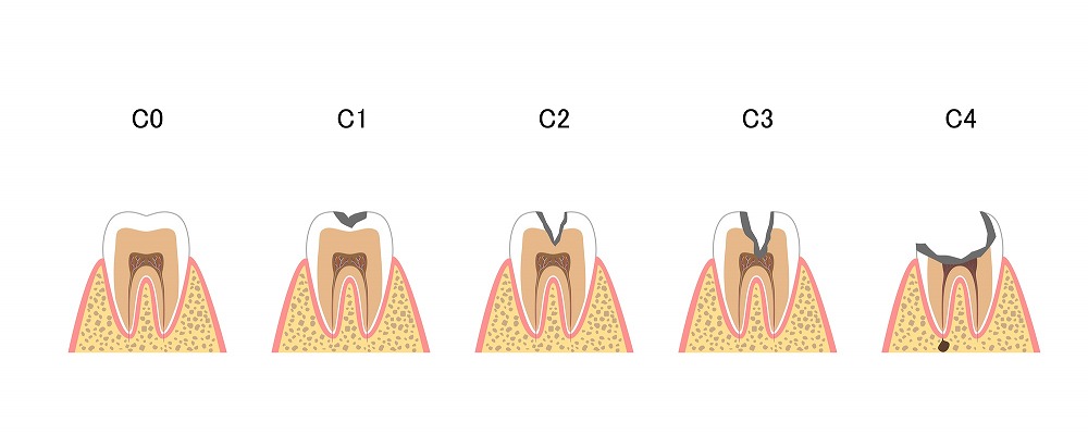 進行したむし歯の治療
