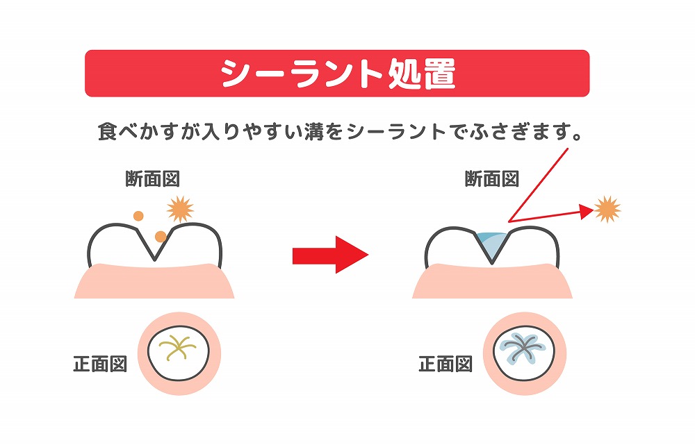 歯科医院でのプロフェッショナルケア