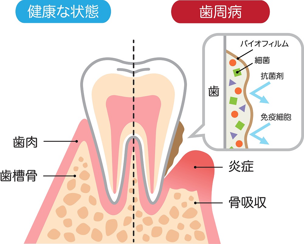 むし歯と並ぶ症状の一つ歯周病