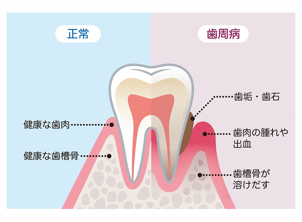 歯周病の症状